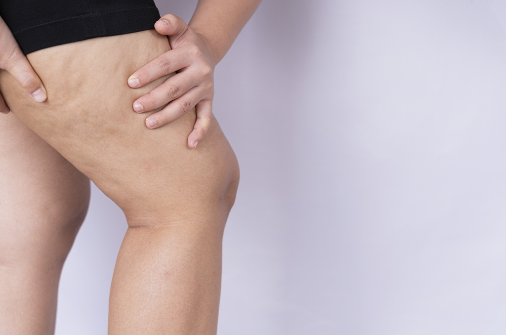 Lipedema: saiba mais sobre a doença que atinge 12,3% das mulheres adultas no Brasil
