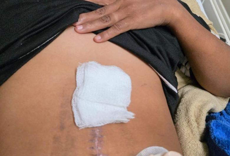 Justiça mantém indenização a paciente do AM que ficou dez anos com gaze esquecida no abdômen
