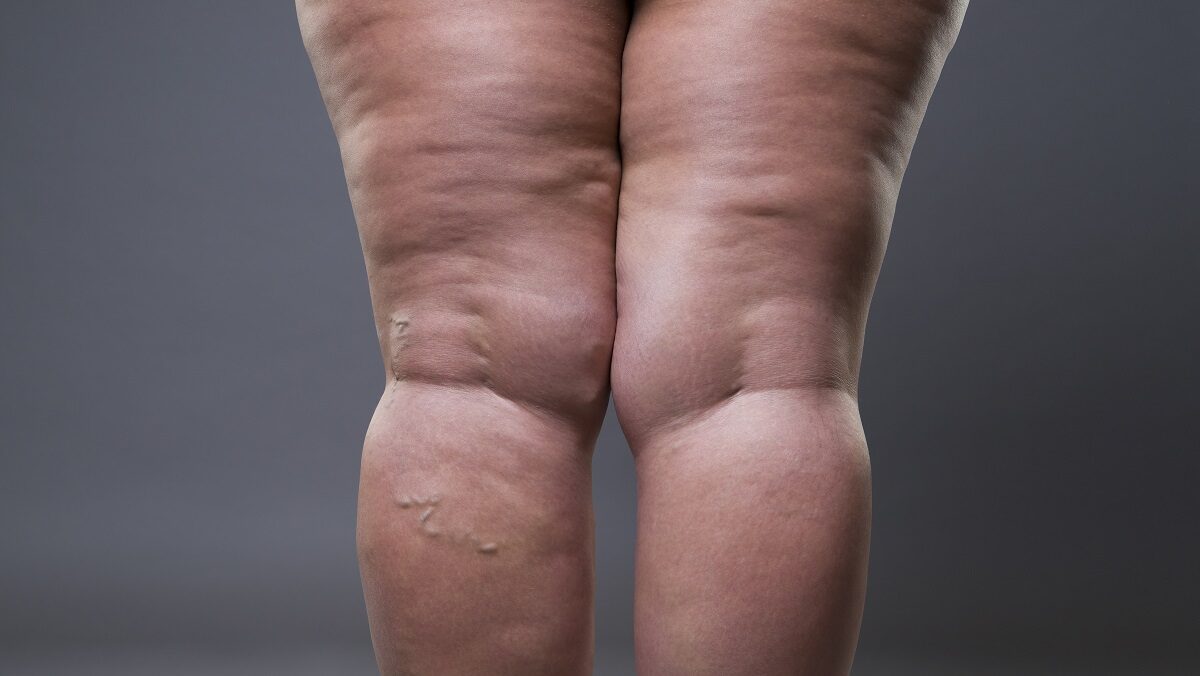 Mulheres com lipedema podem fazer musculação?