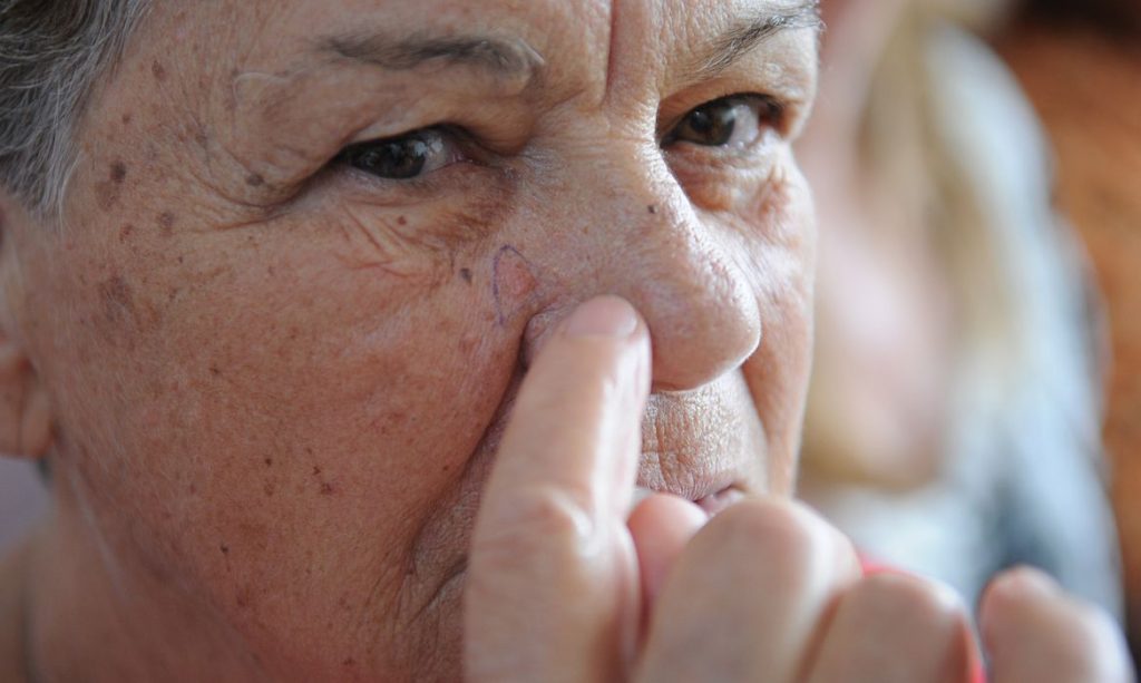 Especialistas alertam para prevenção ao câncer de pele no verão amazônico