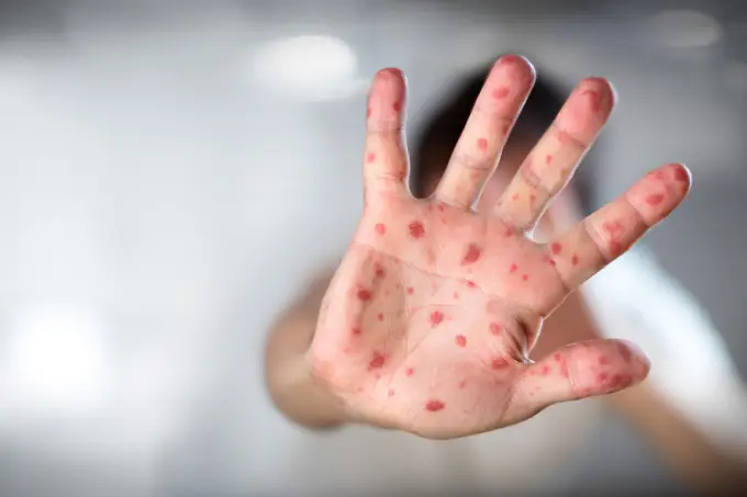 AM confirma primeiro caso de sarampo desde 2020