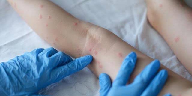 FVS confirma terceiro caso de varíola dos macacos no AM e ressalta que não há ainda transmissão local